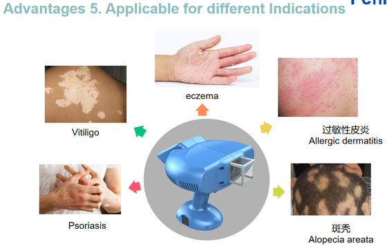 Peninsula Skin Diseases Protective 308NM Excimer Sheet Light Wavelength For Cure
